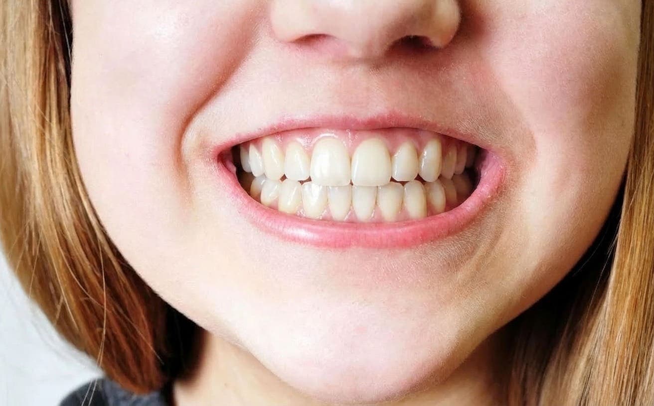 After AI dental preview